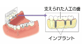 インプラント：複数の歯を失った場合