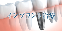 インプラント治療