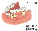 隣接する歯を失った場合