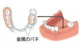 複数の歯を失った場合