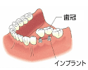 インプラント：隣接する歯を失った場合