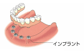インプラント：全ての歯を失った場合