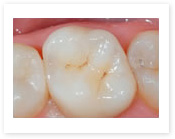 inlay-crown-bond